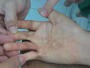 Di chứng chấn thương, sẹo bỏng
