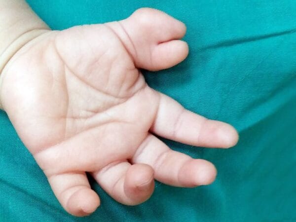 Thừa, dính ngón