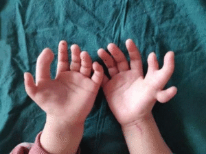 Thừa, dính ngón
